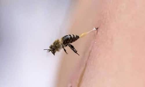 نیش زنبور عسل